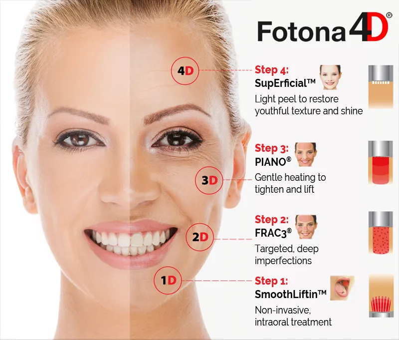 Fotona 4D